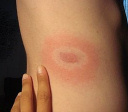 erythema migrans