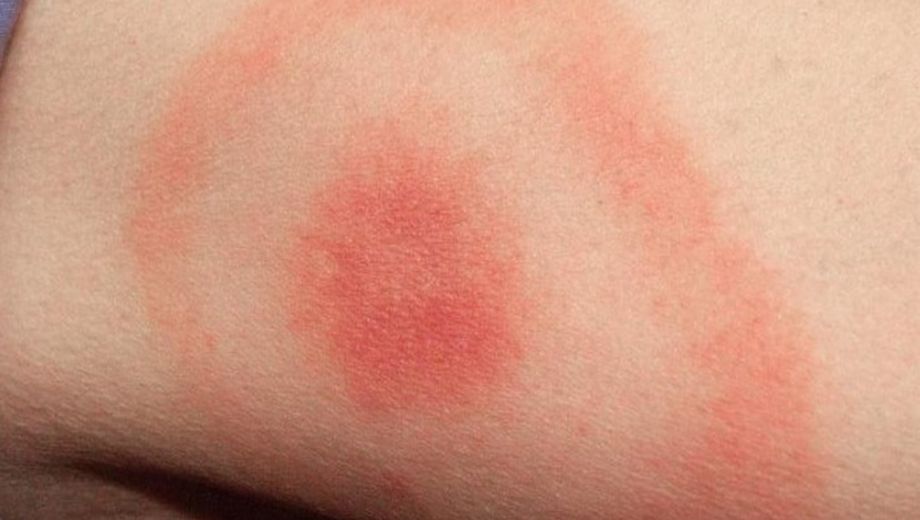 erythema migrans rode kring tekenbeet